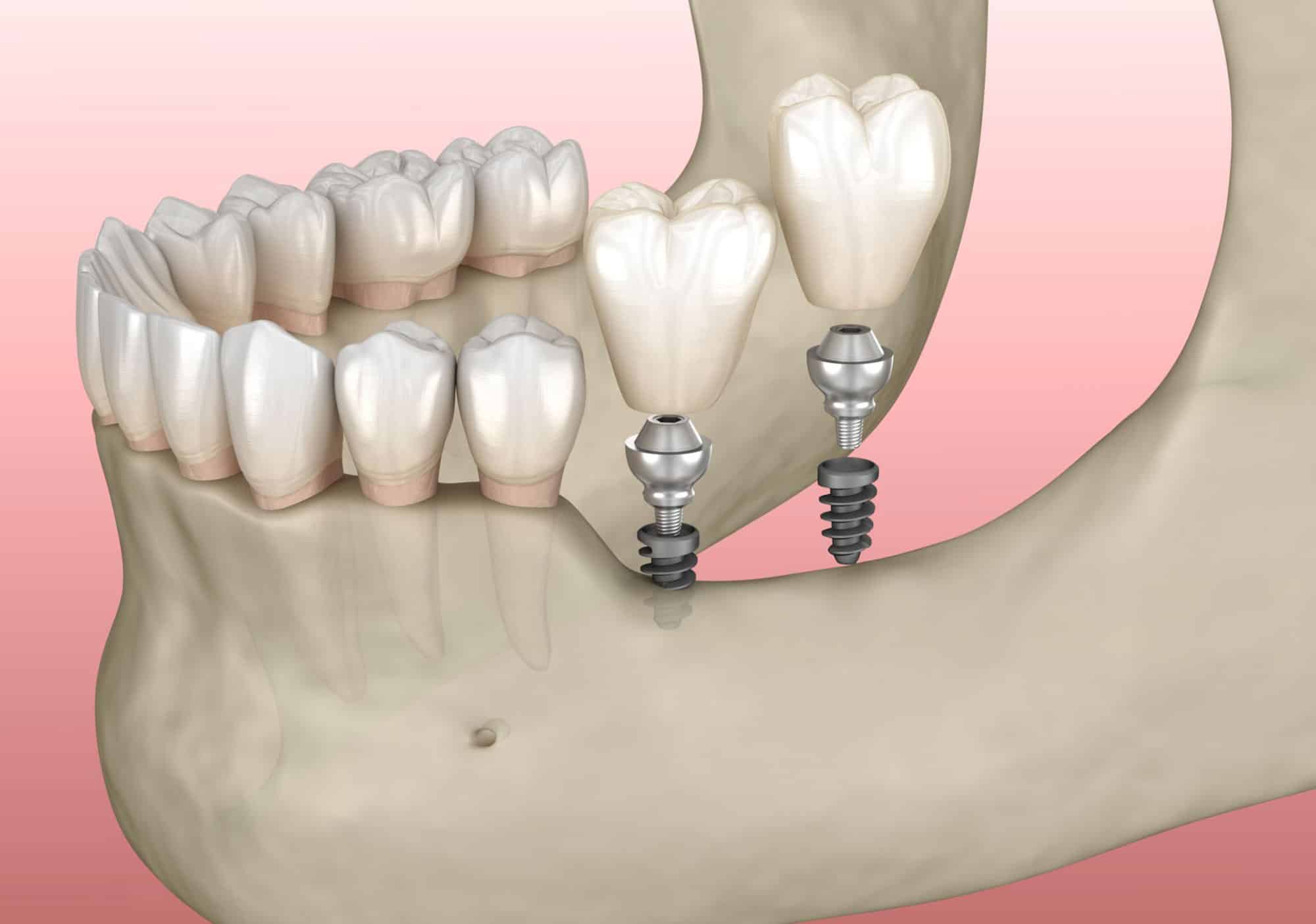Mini implant-supported dentures Hamilton