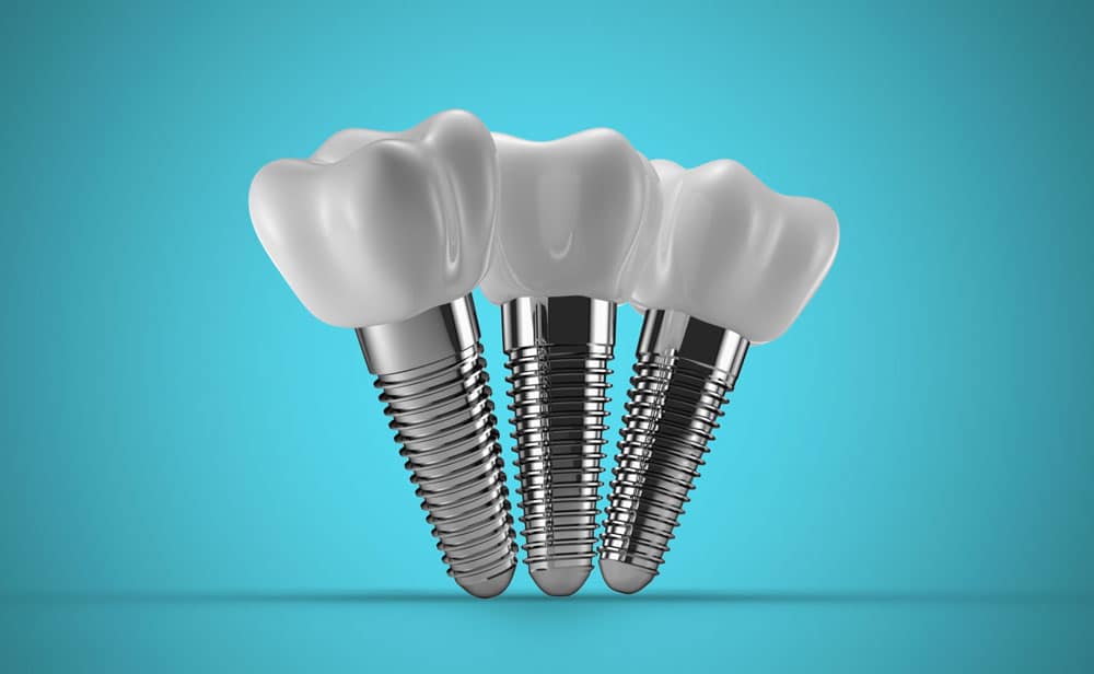 Best dental implant dentist Hamilton