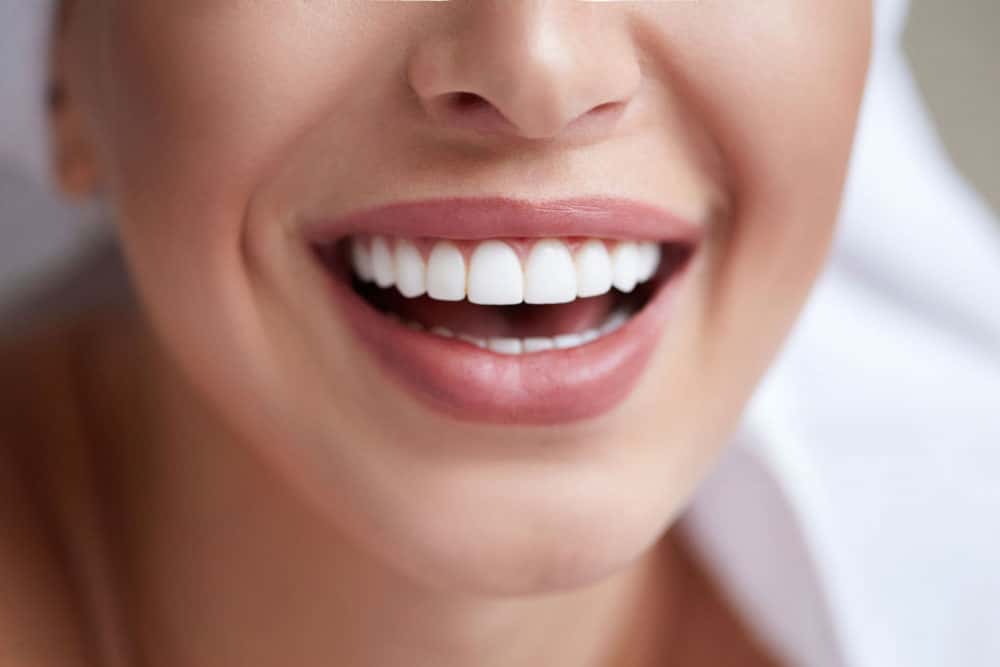 Veneers Hamilton