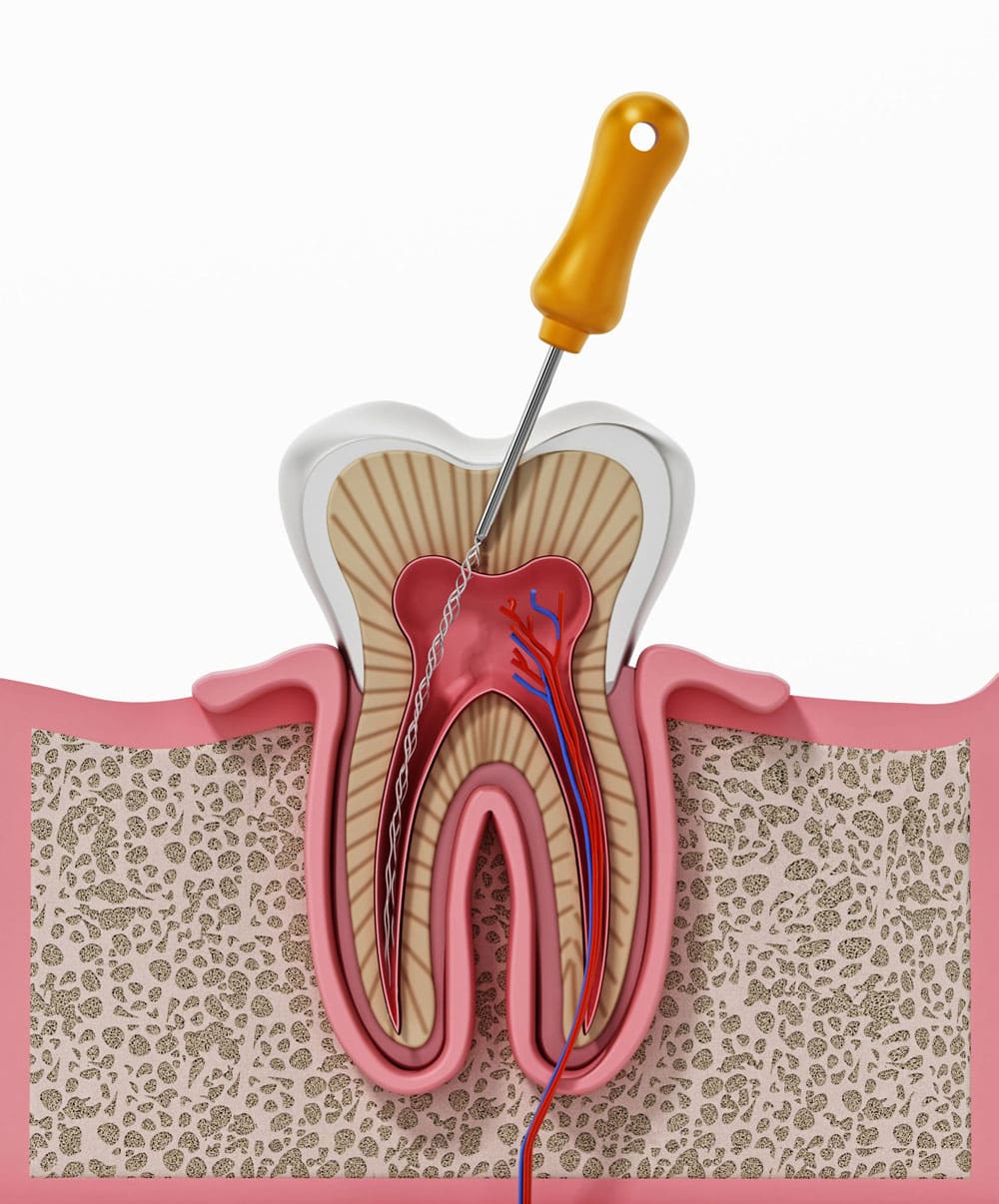 Root canal therapy Hamilton