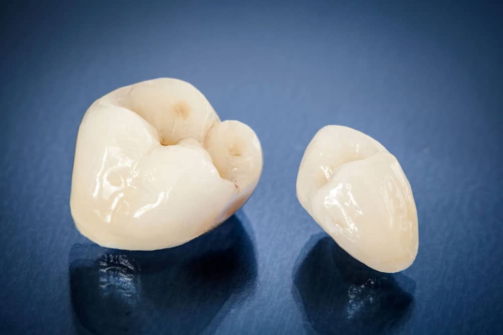 Same-day dental crowns Hamilton