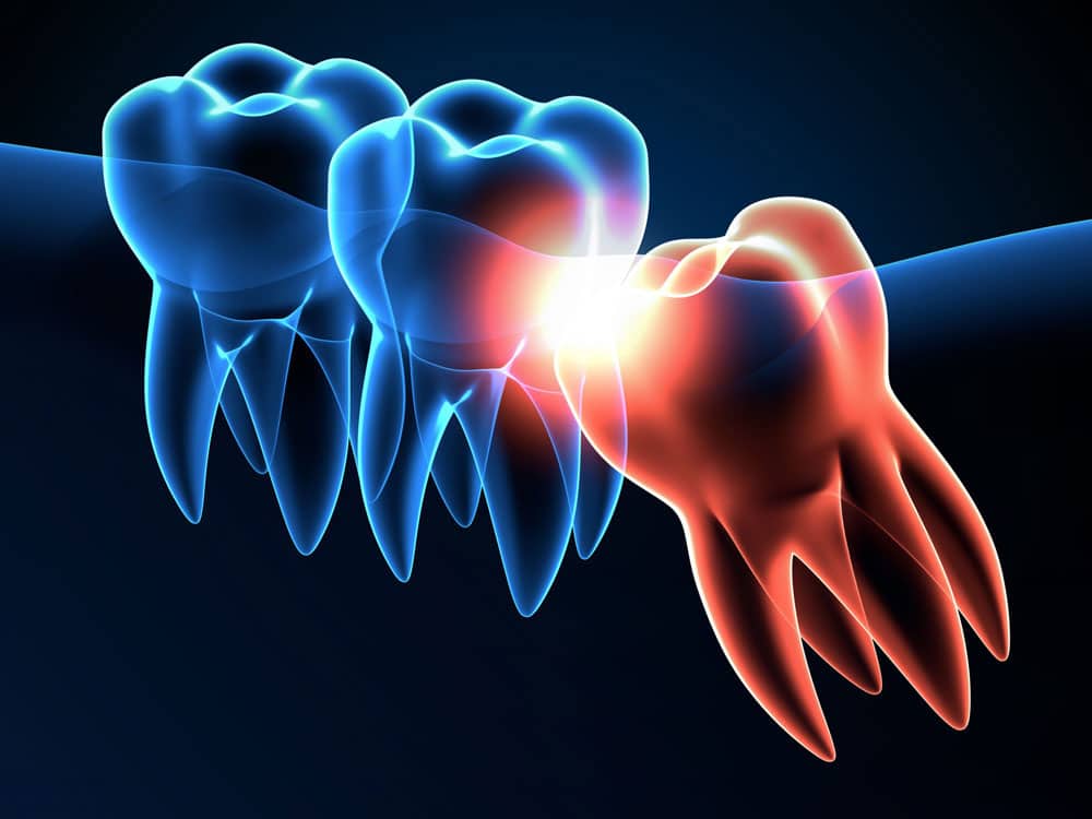 Hamilton dentist wisdom tooth removal