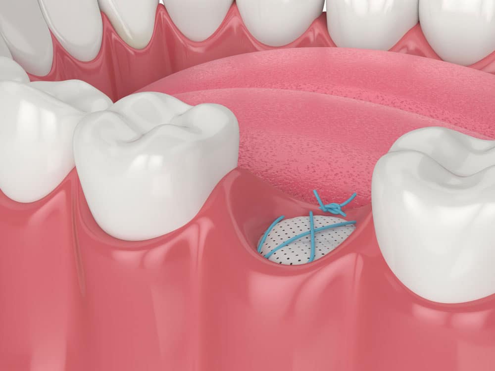 Best bone graft dentist Hamilton