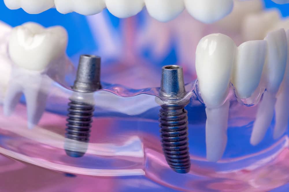 Dental implant services Hamilton