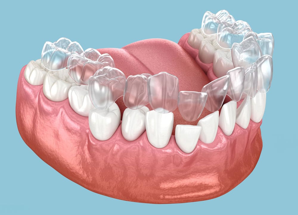 Custom clear aligners Hamilton