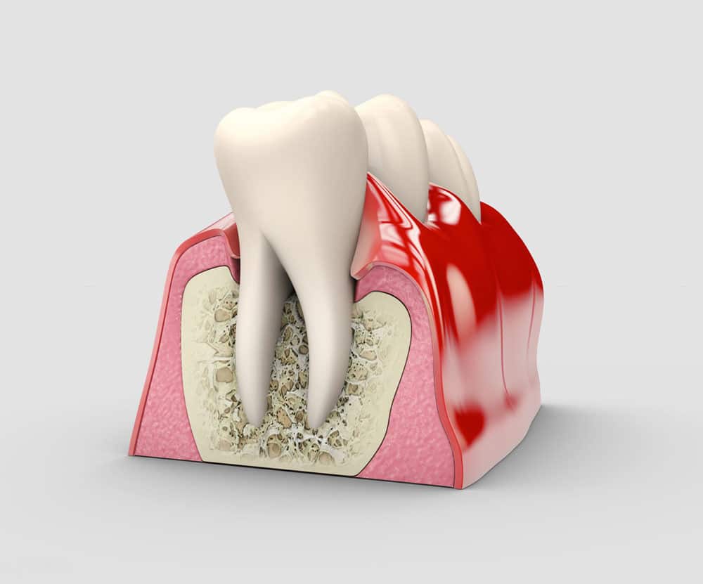 Hamilton gum disease treatment