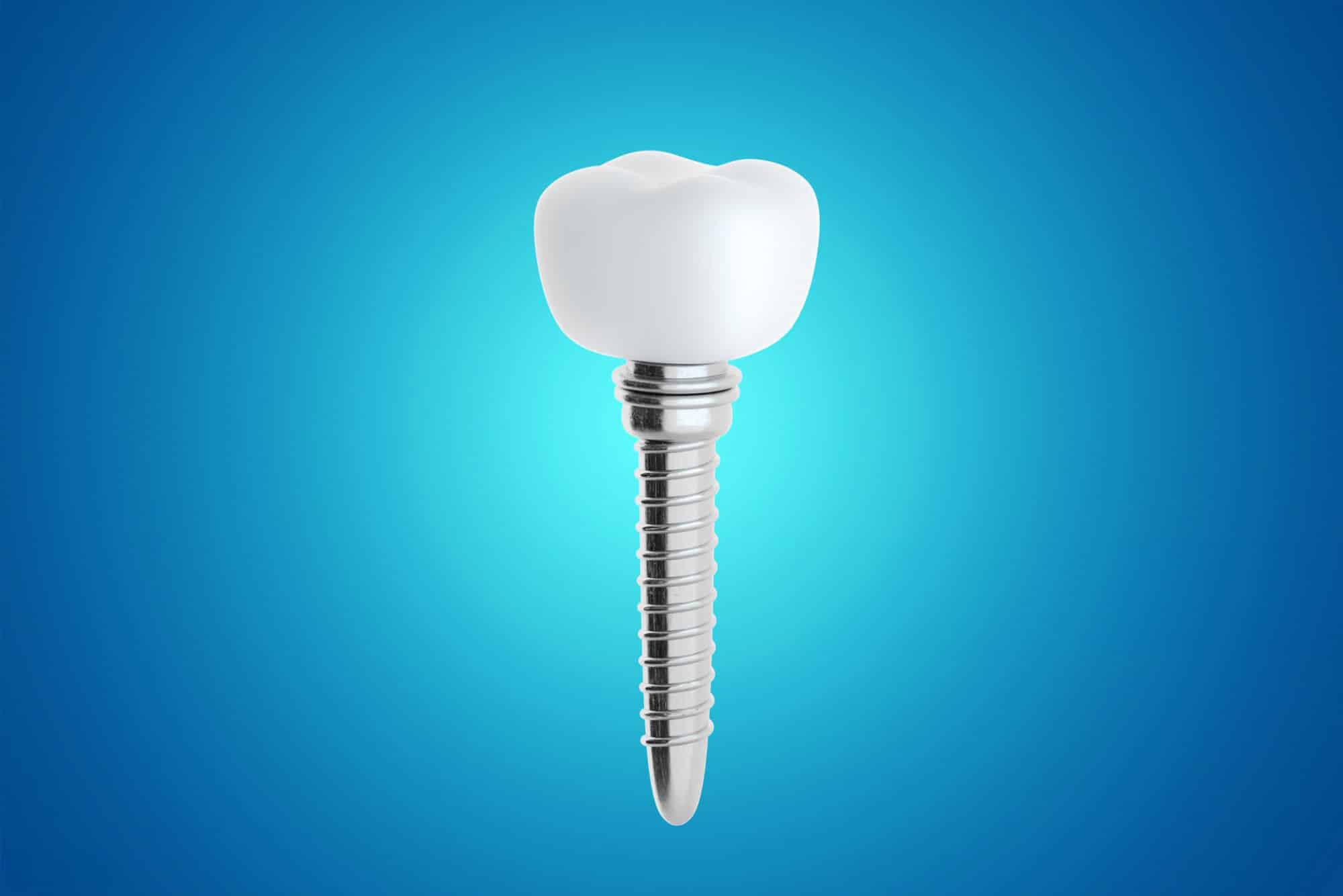 Mini dental implants Hamilton