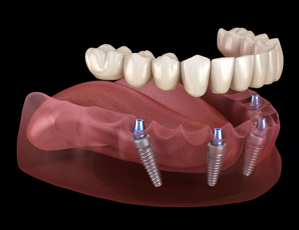 All-on-4 teeth replacement Hamilton