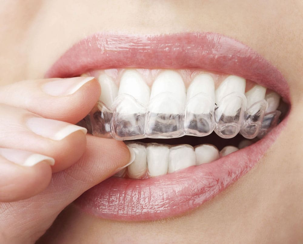 Dentist offering clear aligners Hamilton