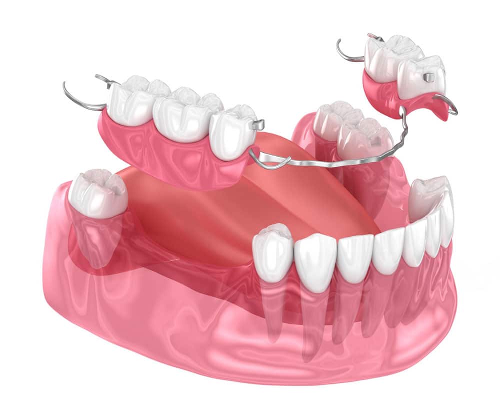 Partial dentures Hamilton