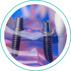 Top implant dentist in Hamilton