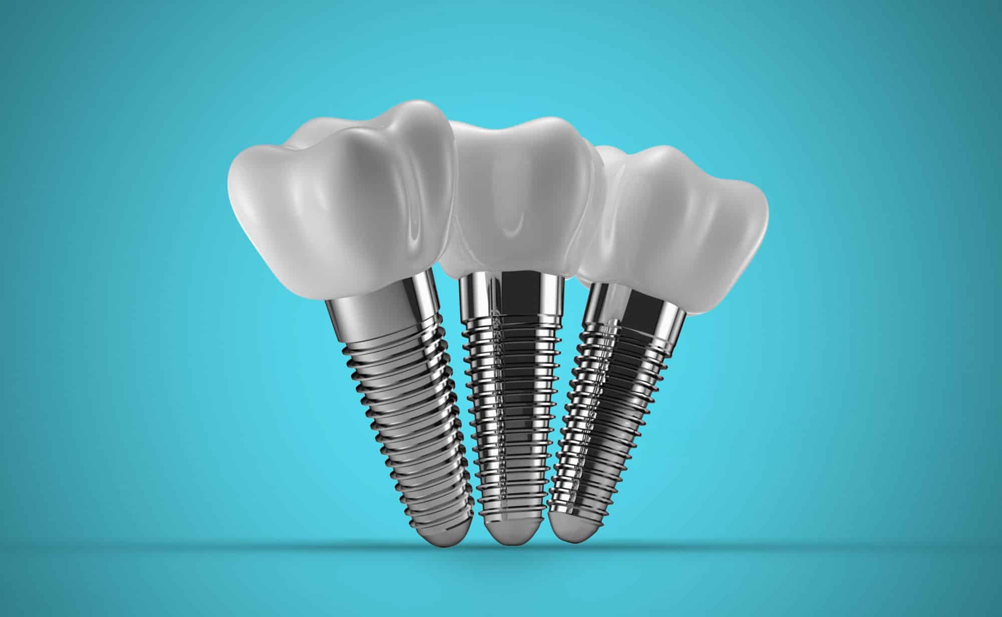 All-on-4 dental implants Hamilton