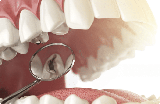 Cavity treatment Hamilton