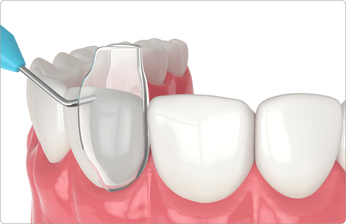 Front tooth bonding Hamilton
