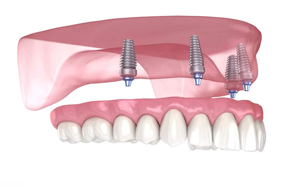 Hamilton All-on-4 implants