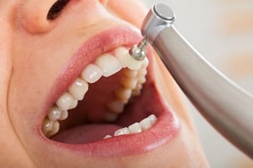 Professional dental cleaning Hamilton
