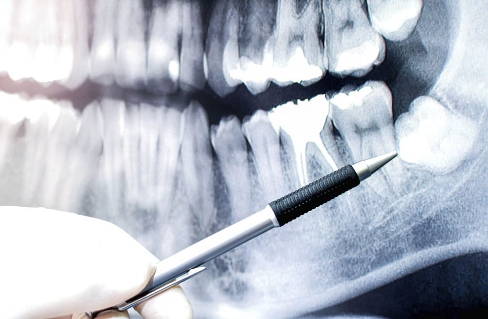 Wisdom teeth extraction Hamilton
