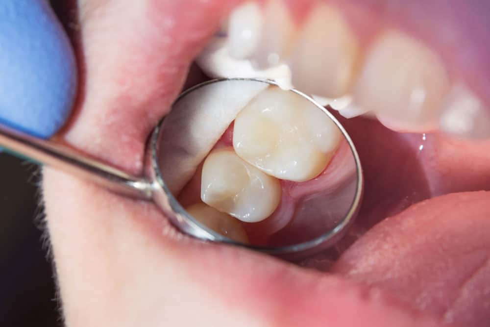 Dental fillings Hamilton