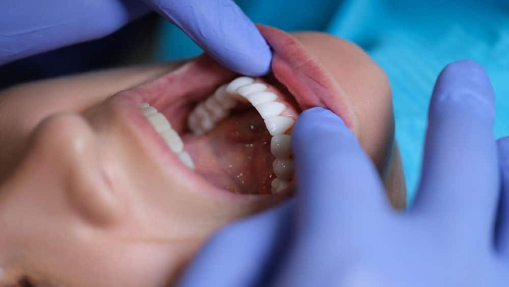 Dental veneers Hamilton