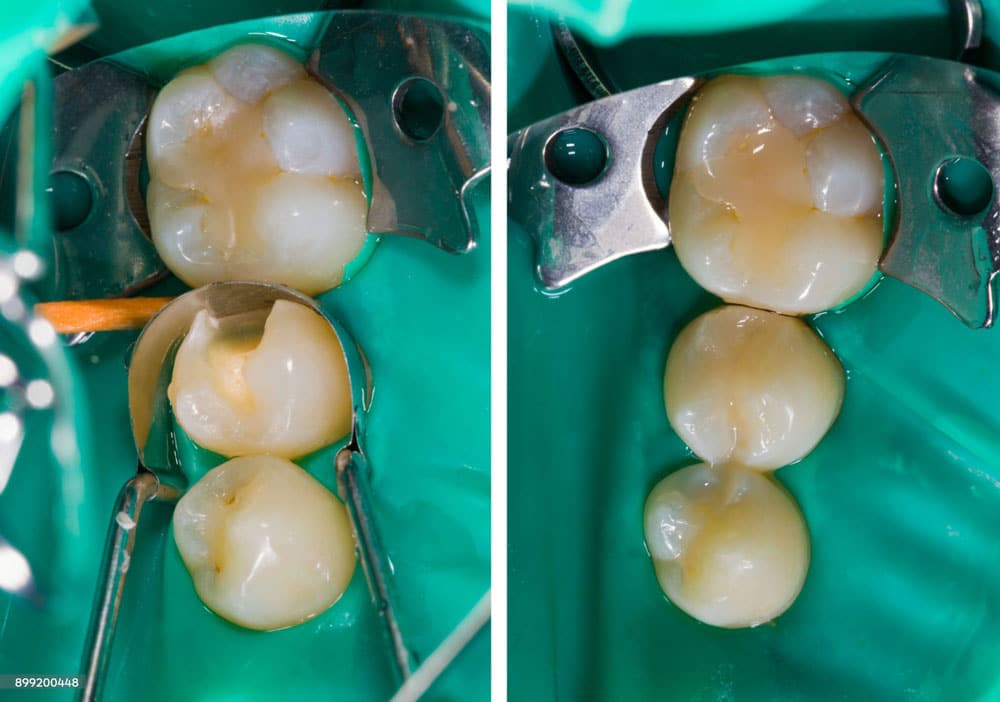 Dentist for fillings Hamilton