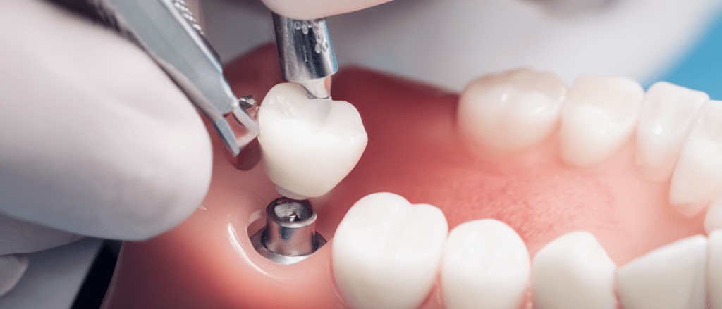 Do dental implants hurt